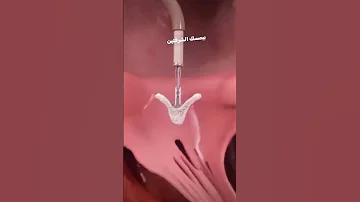 علاج ارتجاع الصمام الميترالي بالقسطرة القلبية 