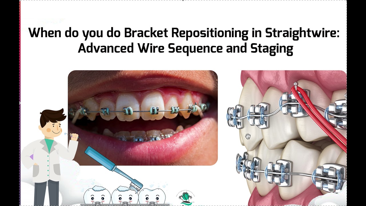Staging and Timing for Bracket Repositioning YouTube