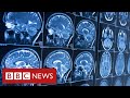 Covid survivors may face life-long brain injuries - BBC News
