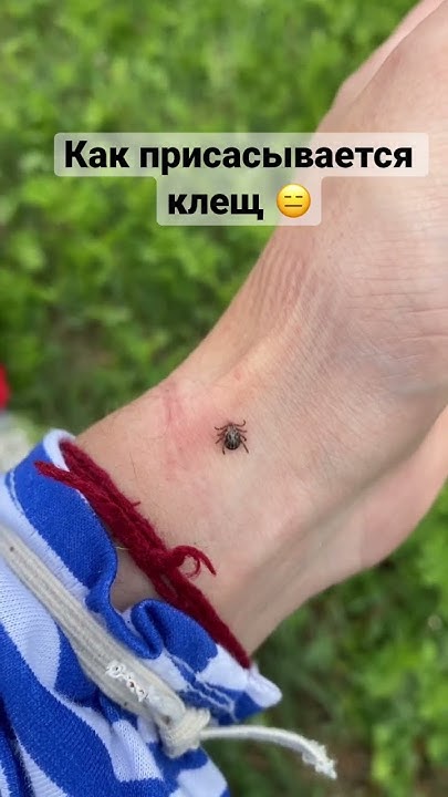 Клещи в лесу/ клещи 2023/ присосался клещ/ как бороться с клещами - YouTube