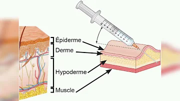 Quelle sont les différents types d'injection ?