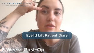 Patient Diary: Hannah's Upper Blepharoplasty/Eyelid Lift