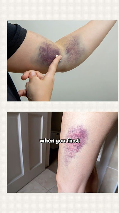 Bruises, Explained