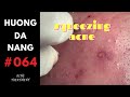 #064 | Squeezing acne for a girl | Nặn mụn cho em gái | Hương Đà Nẵng