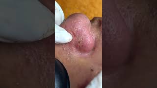Satisfying Relaxing with Vien Tham My DrAZI  #acne #pimples #blackheads