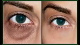 QUICK FIX FOR UNDER EYE BAGS, DARK CIRCLES PUFFY EYES AND TIRED EYES The result is amazing Khichi Be