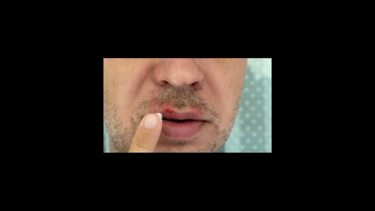 100-natural-herpes-permanent-relief-to-prevent-outbreaks-suppress-the