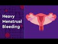 Heavy Menstrual Bleeding and Available Treatment for Teens