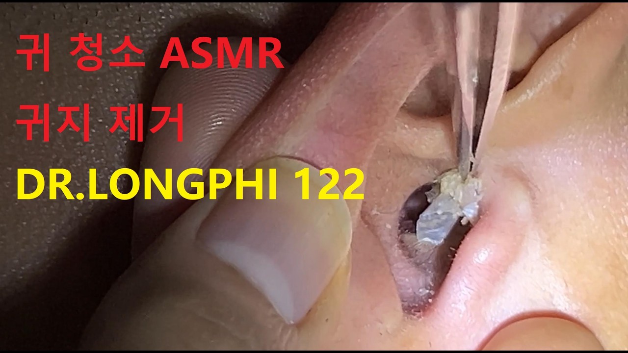 💫 귀 청소 ASMR - 귀지 제거 DR.LONGPHI 122