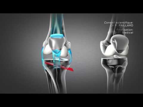 Ostéotomie tibiale de valgisation à Paris | Dr Paillard