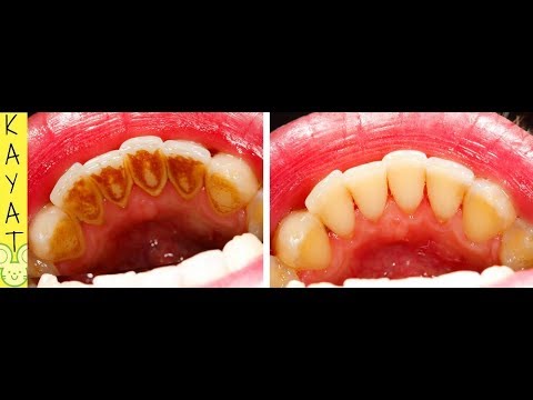 Comment DÉtartrer Les Dents A La Maison