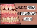 Gingivitis | encías inflamadas | Odontologia Con Cri