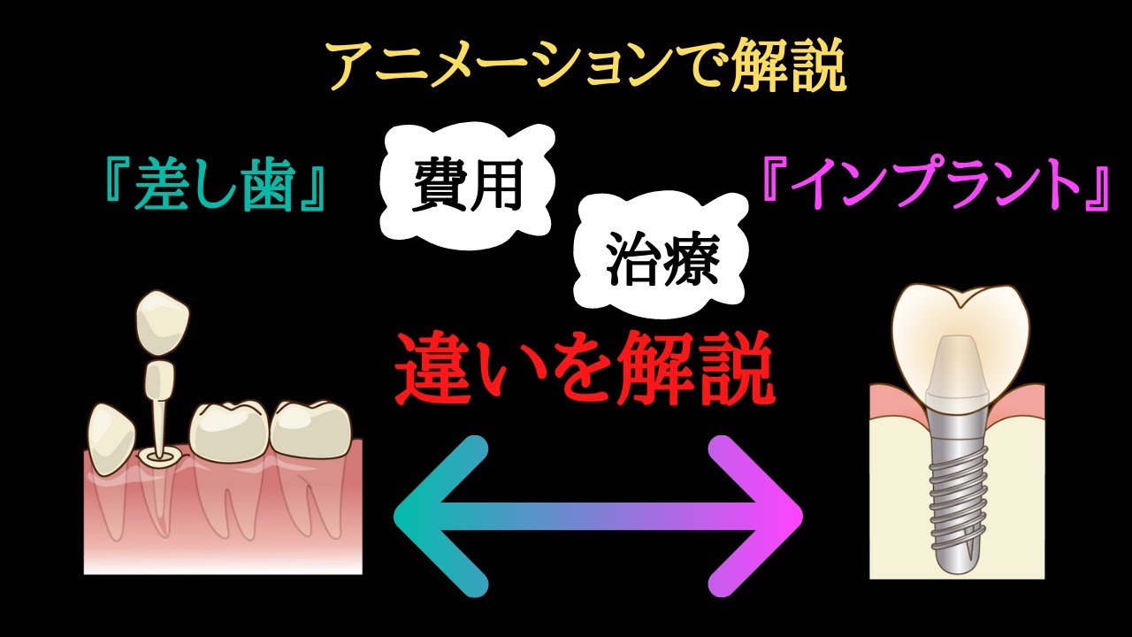 差し歯 と インプラント の 違い