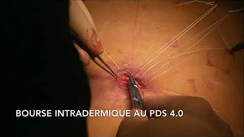 Qual o valor de uma cirurgia plástica no umbigo?