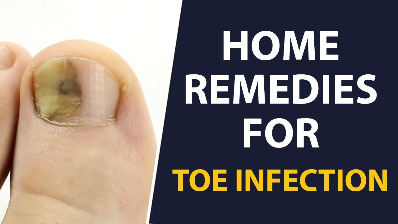 Home Remedies To Get Rid Of A Toe Infection Fast | Remedies For A Toe ...