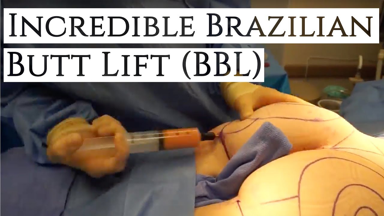 Incredible Brazilian Butt Lift & Breast Revision with RESULTS!