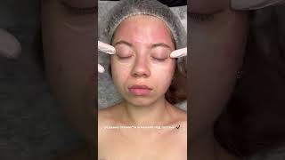 Укрепляем сосуды под глазами #мешкиподглазами #отеки#чисткалица#мезотерапия#косметолог