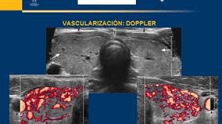 ECOGRAFIA DE TIROIDES PARA PACIENTES