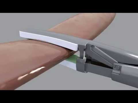 Altrus® Thermal Tissue Fusion (animation)