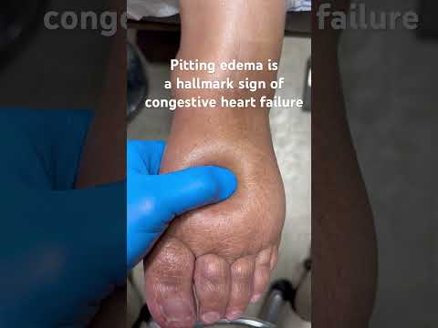Pitting Edema Is