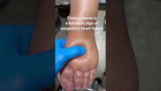 Pitting Edema Is A Sign Of Congestive Heart Failure