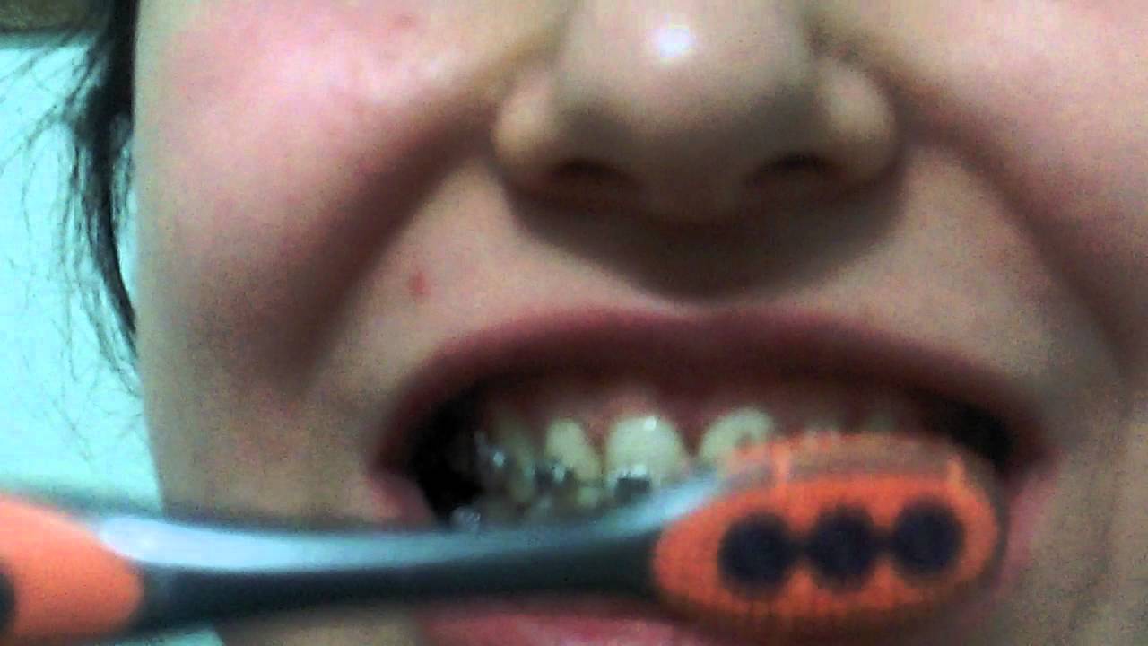 Lingual Ortodonti Gorunmeyen Dis Telleri Hakkinda Merak Edilenler