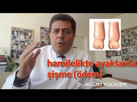 Hamilelikte ayaklarda şişme (ödem) için bitkisel ilaçlar ve tedavi çözümleri?