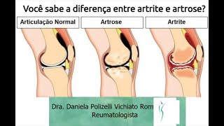 Diferenças entre Artrite e Artrose