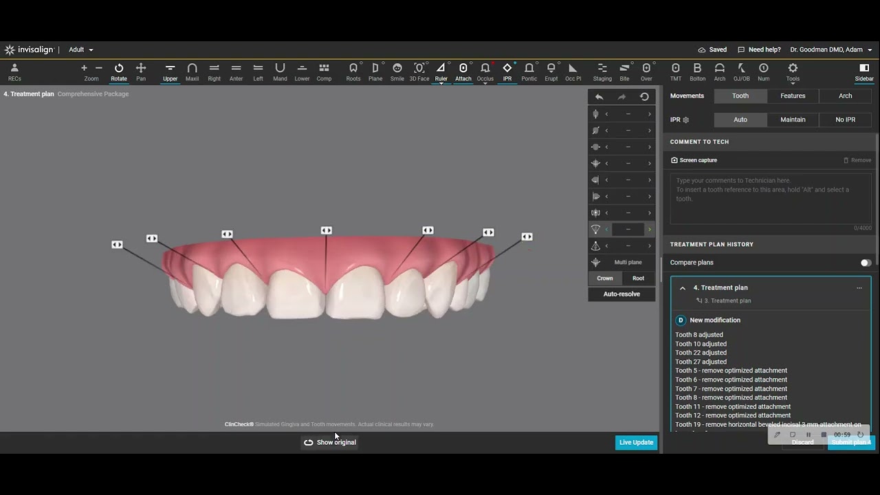 Invisalign Clincheck Construction to Minimize attachments and Maximize Tracking