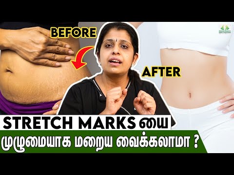 How to Remove Stretch Marks | Dr Deepthi Jammi, Cwc | Home Remedies Tamil, Post Pregnancy Problems