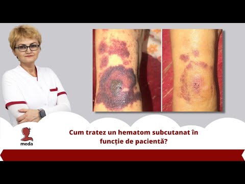 Video: Hematom La Picior: Cauze, Simptome și Tratamente