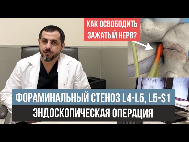 Радикулярный синдром