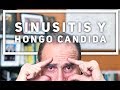 Episodio #1253 Sinusitis y hongo cándida