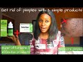 How to use dudu osun black soap & tea tree oil to get rid of pimples/ effective products for pimples