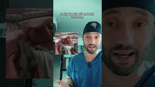 Rare Birth Defect, Called Anencephaly. Usually Caused By A Folic Acid Deficiency.