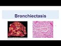 Bronchiectasis