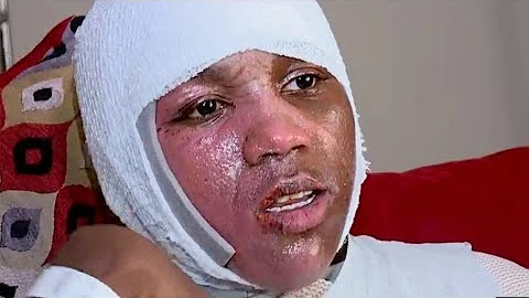 Hot Water Challenge Reportedly Leaves Teen With Second-degree Burns