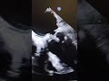 mitral valve endocarditis in TEE #cardiology #medicalshorts #tee