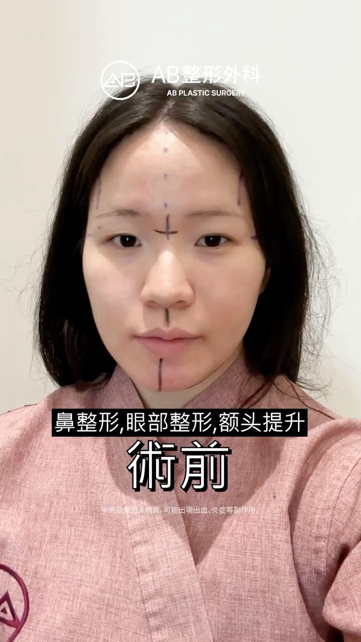 眼部整形＋鼻整形，這次真的美出新高度🤍 #Shorts