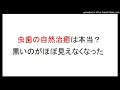 虫歯の自然治癒は、自分で経験。虫歯って削らなくても直る。自力で虫歯を治した方法。羊水がシャンプー臭くなる