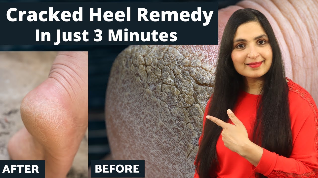 How to Fix Cracked Heels Permanently at Home With Ayurveda – Vitro Naturals