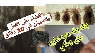 #علاج القمل# والصيبان عند الكبار والصغار بعشبه سحريه في 10 دقائق الوداع القمل والصيبان