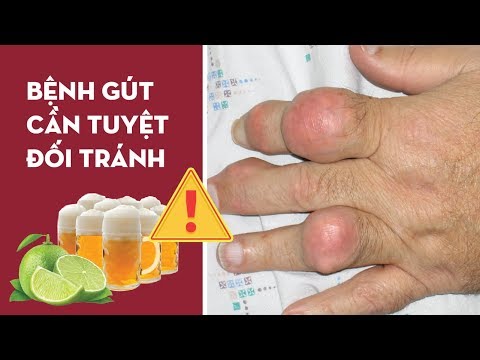 Những thực phẩm người bị bệnh gút cần tuyệt đối tránh