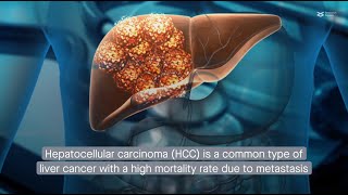 M2 macrophage–derived exosomes promote metastasis in hepatocellular carcinoma