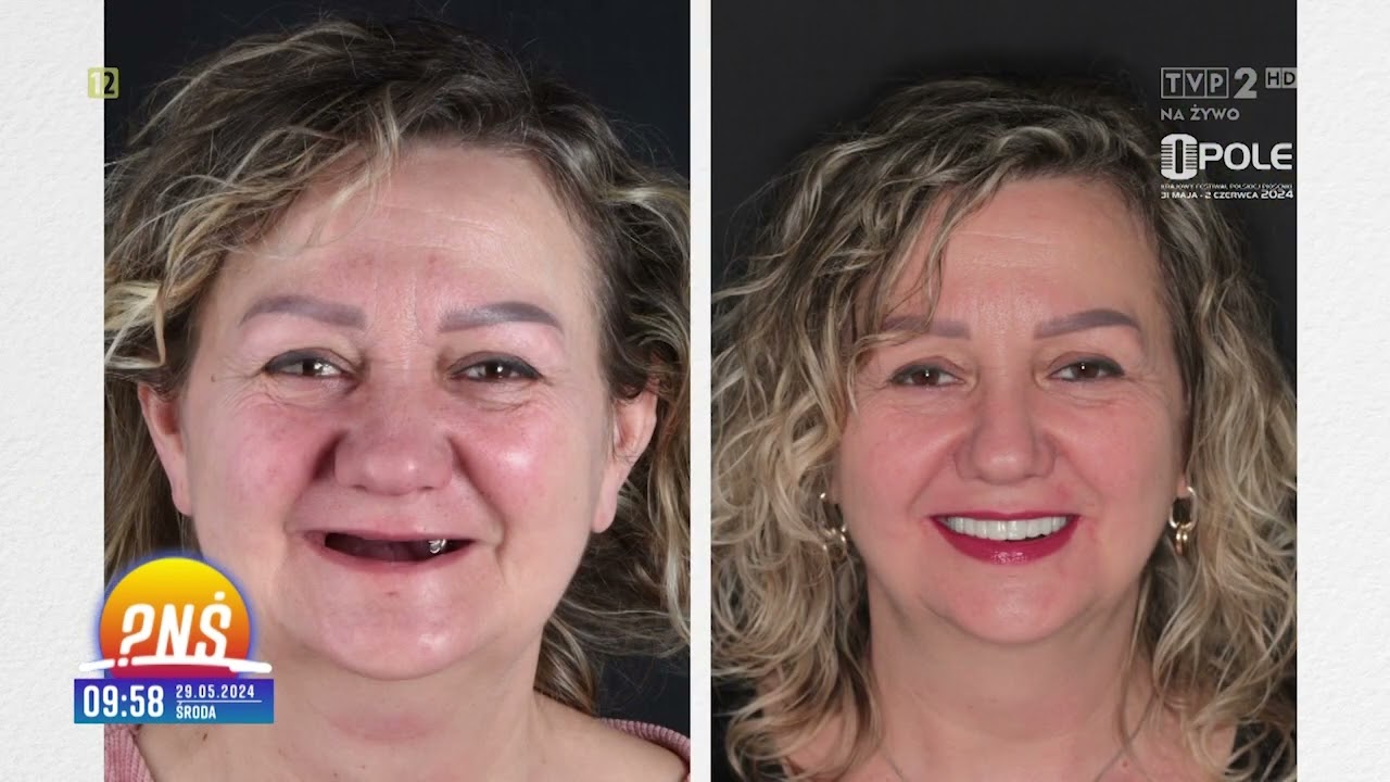 2024-05-29 NOWY UŚMIECH W JEDEN DZIEŃ! | NIEZWYKŁA PRZEMIANA PANI BEATY