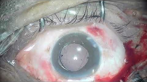 NOV 27 PCR DRY ASPIRATION