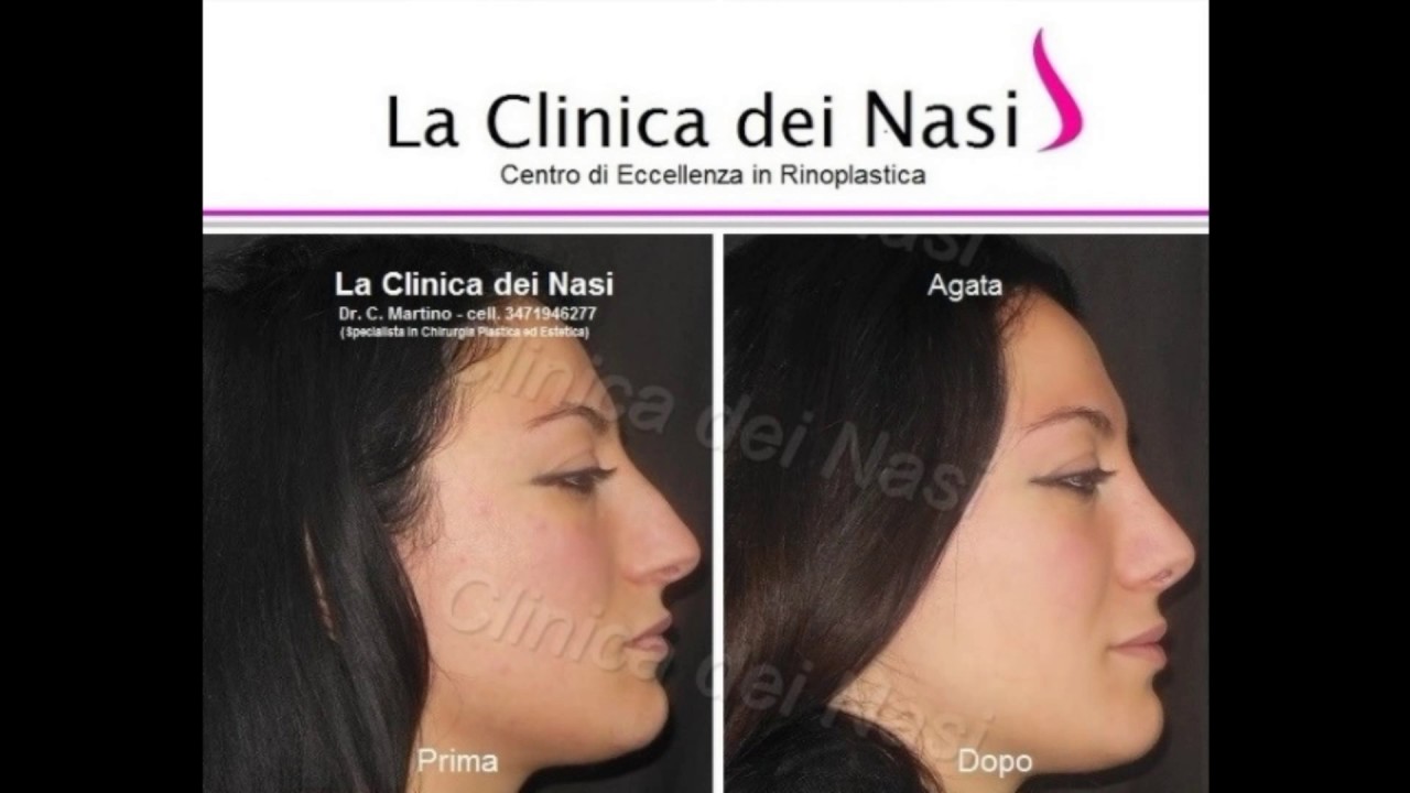 Eliminazione Gobba Foto Agata Presso La Clinica Dei Nasi Youtube