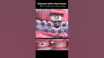 Cách kéo răng mọc ngầm khi niềng răng #shorts #braces #orthodontist
