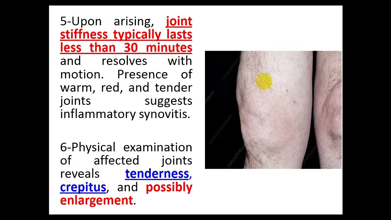 Osteoarthritis 2024 By Dr  Dheyaa Jabbar