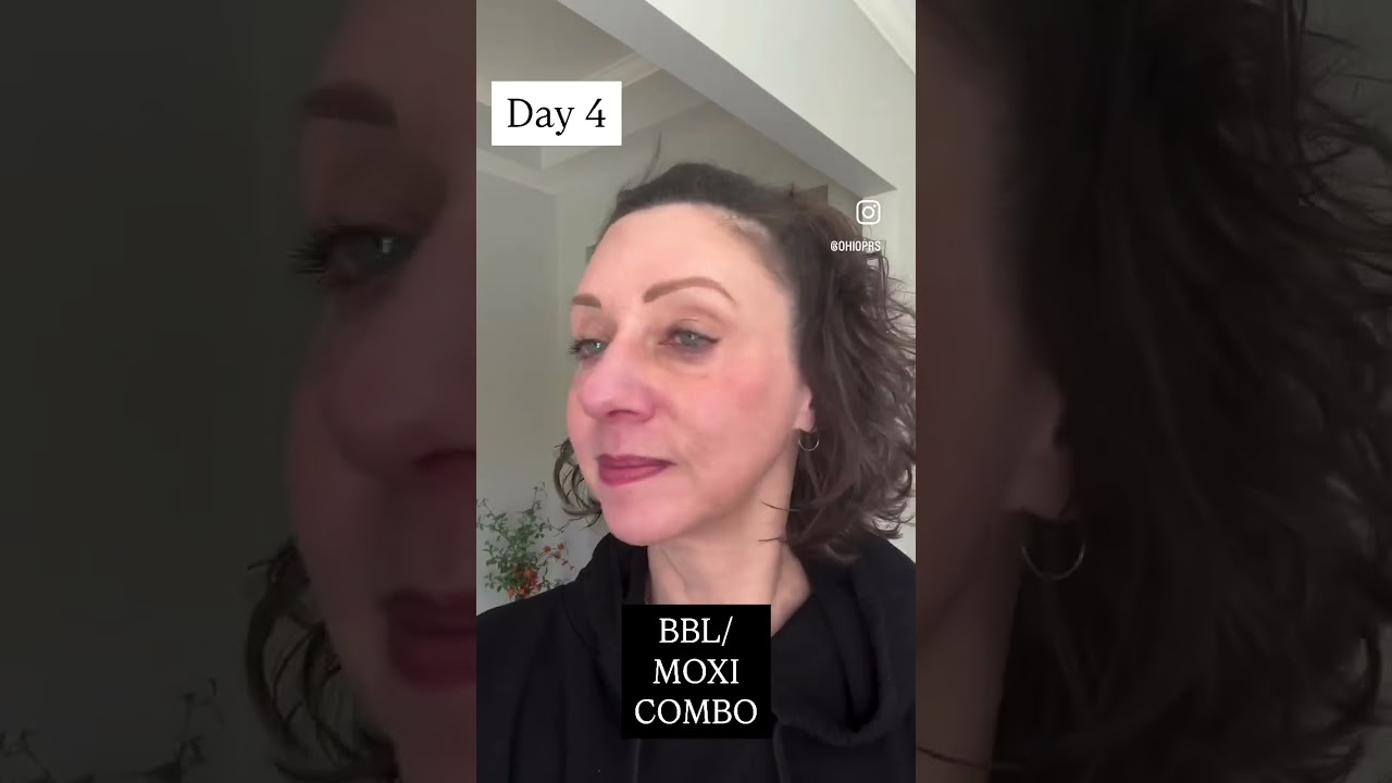 For the Ultimate Glow: Broadband Light + MOXI